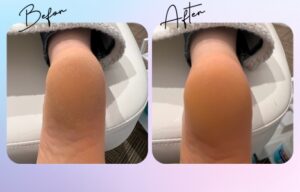 かかと角質ビフォーアフター