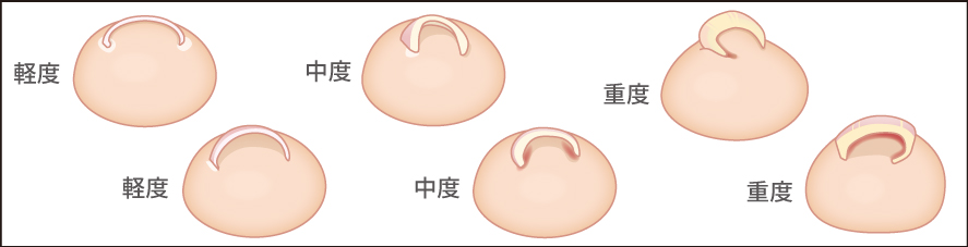 巻き爪症状の分類