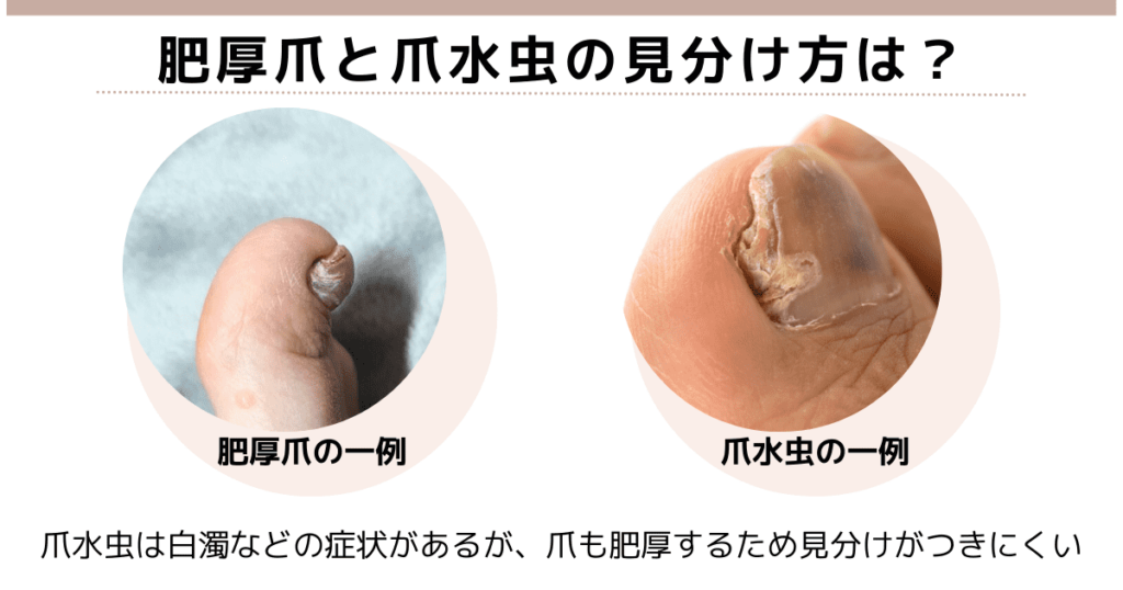 肥厚爪と爪水虫の見分け方