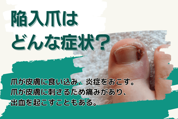 陥入爪はどんな症状？