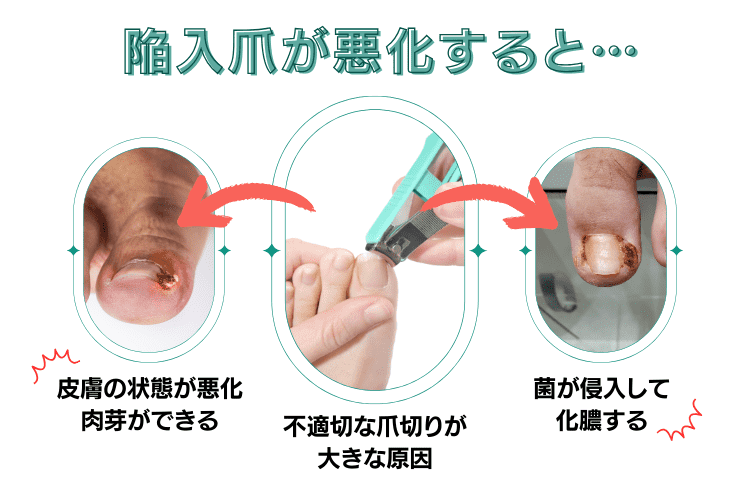 陥入爪の原因と悪化した場合の状態について