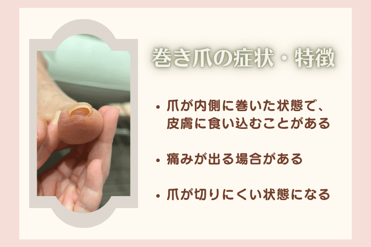 巻き爪の症状と特徴