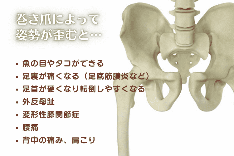 巻き爪による姿勢の歪みの弊害について