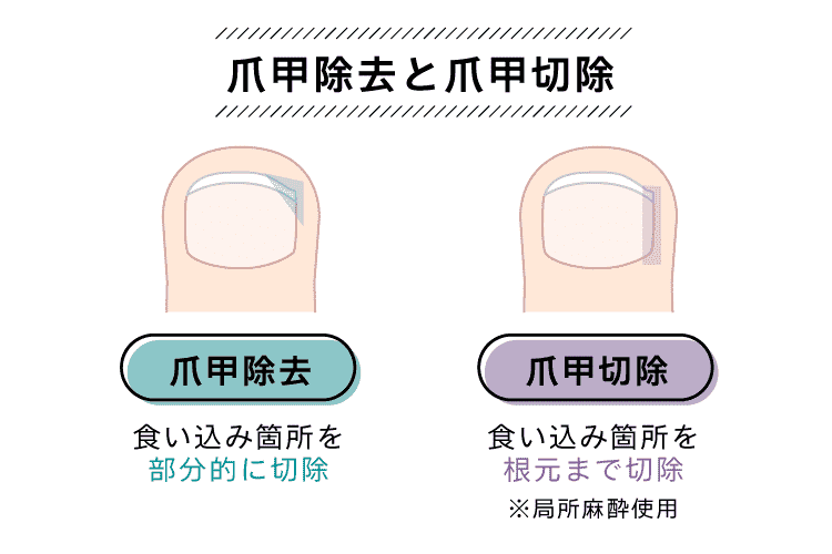 爪甲除去と爪甲切除