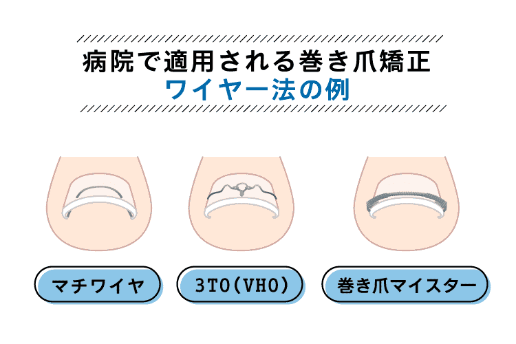 巻き爪矯正「ワイヤー法」