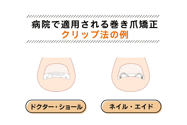 巻き爪矯正「クリップ法」