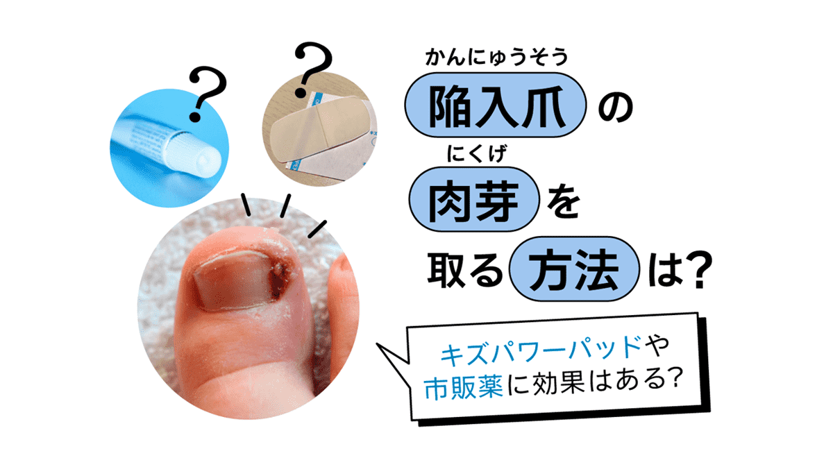 陥入爪の肉芽を取る方法は？キズパワーパッドや市販薬に効果はある？