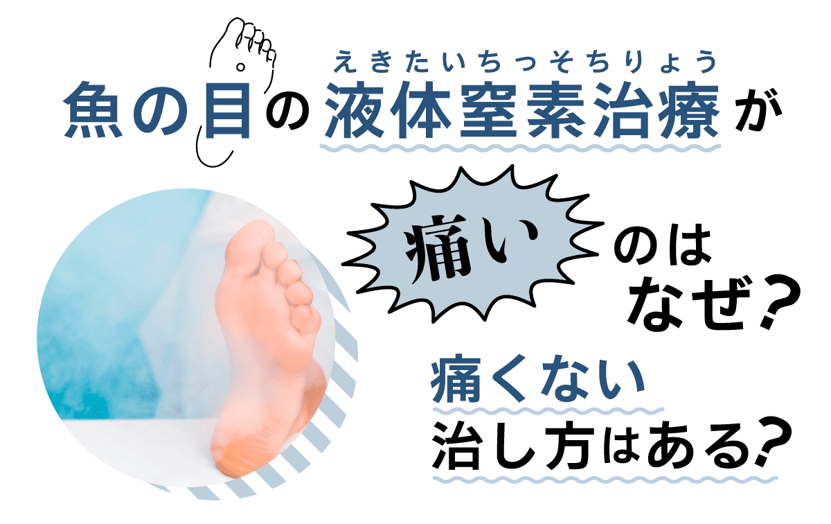 魚の目の液体窒素治療が痛いのはなぜ？痛くない治し方はある？