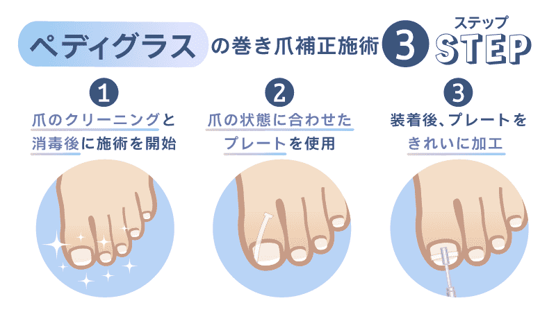 ペディグラスの巻き爪補正施術3つのステップ