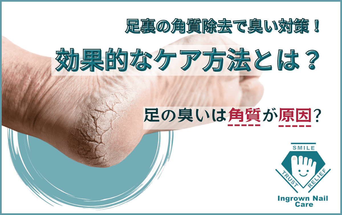 足の臭いは角質が原因？足裏の角質除去で臭い対策！効果的なケア方法とは？